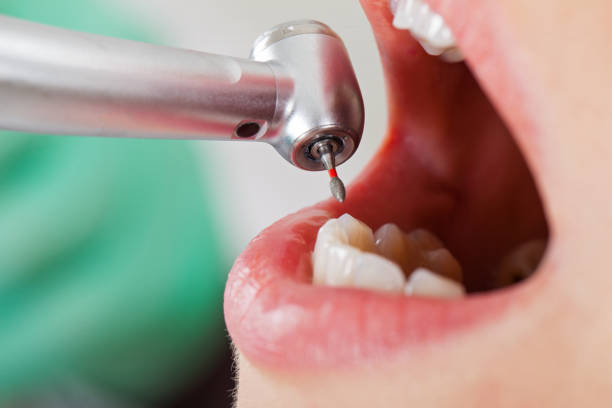 Best Emergency Wisdom Teeth Removal in Bellwood, PA